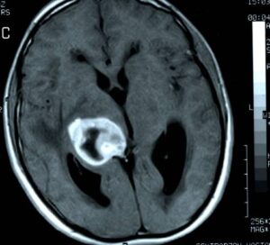 Nörogörüntüleme Yöntemleri Günümüzde Parkinson hastalığında klasik beyin MR’ı genellikle normal çıkar. Ancak fonksiyonel görüntüleme teknikleri erken tanıda yardımcı olabilir.